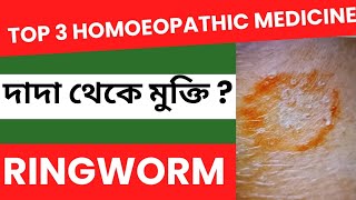 দাদের  RingWorm  বেস্ট হোমিওপ্যাথি ঔষধ ।  RingWorm problem Homoeopathic Treatment and Medicine [upl. by Stedmann286]