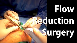 AVF Flow reduction surgery Graft interposition Radiocephalic 동정맥루 혈류 감량 수술 인조혈관 치환 [upl. by Arraik]