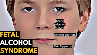 Fetal Alcohol Syndrome Causes Signs and Symptoms Diagnosis and Treatment [upl. by Gagliano974]