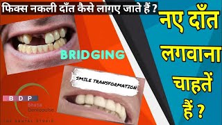 हिलते दांतो को निकालनए दांत लगाना सुंदर मुस्कान smile transformation with dental bridging bridge [upl. by Mora171]