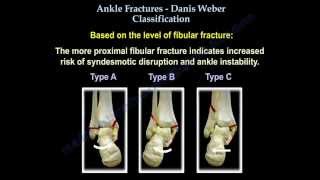 Ankle Fractures Danis Weber Classification  Everything You Need To Know  Dr Nabil Ebraheim [upl. by Naut894]