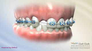 Bonded Bridge  Orthodontic Treatment [upl. by Dennet557]