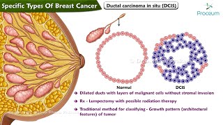 2 Specific types of Breast Cancer [upl. by Nagear]