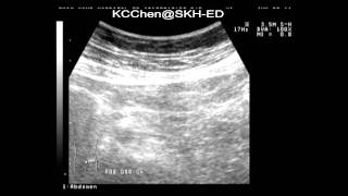 Epiploic appendagitis [upl. by Brion522]