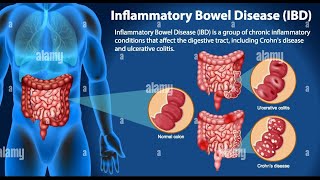 Understanding Inflammatory Bowel Disease IBD A group of intestinal disorders trending ibd [upl. by Adamina]