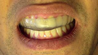 Bruxism Splint  Part 6  Insertion and Occlusion [upl. by Annot]