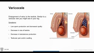 Varicocele Overview amp Treatment [upl. by Akila]