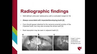 Dentigerous Cyst [upl. by Ihdin]