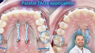 Wide range of palatal TADs applications mini screws palatelly benefits of mini implants in palate [upl. by Hinze]