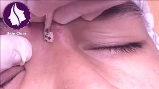 Blackheads Removal On Forehead  Get rid of Pimples  16 [upl. by Trudi]