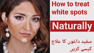 How to treat white spots  سفید داغوں کا علاج کیسے کریں [upl. by Adniles]