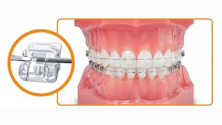 Which braces are better Damon Clear or Damon Metal [upl. by Aciemaj]