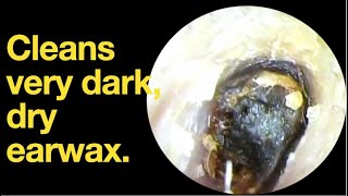 Cleans very dark dry earwax ear wax removal  ear cleaning  ASMR  relaxation  relax [upl. by Oreves95]