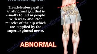 Trendelenburg Gait  Everything You Need To Know  Dr Nabil Ebraheim [upl. by Evangelia]