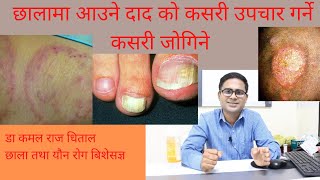 क्षयरोग  TB in Nepali  Tuberculosis Symptoms Causes and Treatment in Nepali  TB  By Naya Health [upl. by Ignatia377]