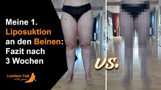 Meine 1 Liposuktion an den Beinen  Fazit nach 3 Wochen [upl. by Ennyrb]