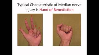 Typical Characteristic of a Median nerve injury [upl. by Tryck]