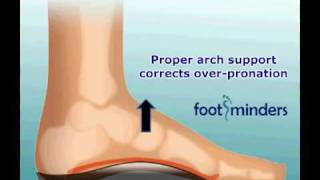 Foot Pain Due to Flat Feet and OverPronation An Easy Solution [upl. by Moina]