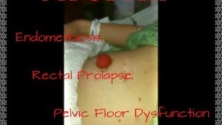 My Story Part 1 Endometriosis Rectal Prolapse Pelvic Floor Dysfunction amp Loop Ileostomy [upl. by Thorvald]