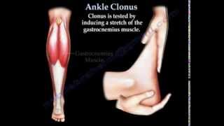 Ankle Clonus  Everything You Need To Know  Dr Nabil Ebraheim [upl. by Eyatnod]