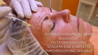 Mesotherapie mit Hyaluronsäure  Behandlung Vorher Nachher [upl. by Reve]