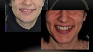 Serie Invisalign Diastema superior [upl. by Etnoj210]