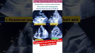 Pericardial Effusion echo l Subcostal view l हार्ट के चारु तरफ पानी echo shorts [upl. by Nylaret]