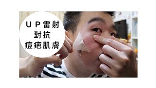 三重知名皮膚科治療！治療痘疤凹洞：UP雷射心得 （上集）  Bolow 菠蘿 [upl. by Lyrradal]