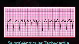 Introduction to EKG Rhythm Interpretation Part 3 [upl. by Nnaesor]