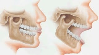 Orthotropic Treatment of Jaw JointTemporomandibular Disorder TMD by Dr Mike Mew [upl. by Sontag639]