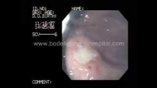 CANCER STOMACH  ENDOSCOPY GUJARATINDIA BODELI [upl. by Asiil152]