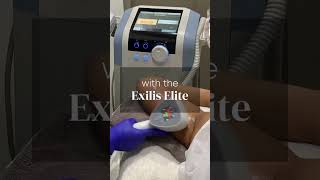 Sagging Arms Begone with Exilis Elite [upl. by Fleisher]