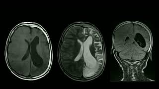 CASE  2 DYKEDAVIDOFFMASSON SYNDROME [upl. by Thurman]