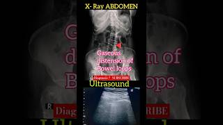 Gaseous distension of bowel loops  X  Ray Abdomen amp USS Abdomen  Diagnosis  Radiology [upl. by Shem503]