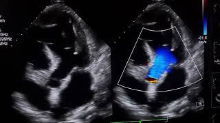 RWMAModerate LV DysfunctionTrace pericardial effusionpleural effusion cardioheartcondition [upl. by Nadeau]