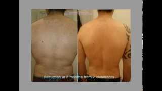 Male back clearance by electrolysis [upl. by Otilopih]