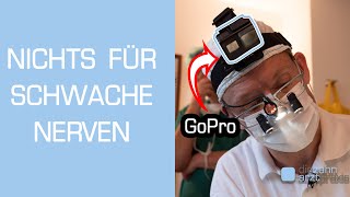 Zahnarzt filmt Weisheitszahn OP mit GoPro Vollnarkose [upl. by Gianina]