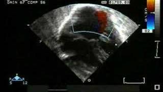 AV Canal Defect with Single Atrium and PDA [upl. by Archle73]