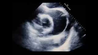 Transthoracic Echocardiogram Showing Pericardial Tamponade [upl. by Giacomo]