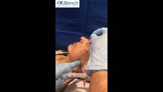 Tratamiento Hilos de Oro  Elimina la Flacidez Facial [upl. by Legir]