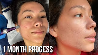 Best way to remove acne scars Microneedling Session 2 [upl. by Riplex]