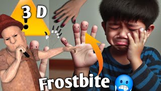 FROSTBITE शीतदंशहिमदाहतुषारदंश3D ANIMATION [upl. by Kyriako]