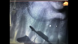 Endodoncia en vivo [upl. by Idzik383]