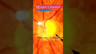 Myopic Crescent  Fundus Photography  Tesselations  Short Video 100 [upl. by Ened]