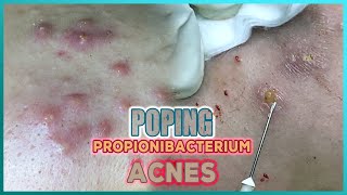 Big Cystic Acne Blackheads Extraction Blackheads amp Milia Whiteheads Removal Pimple Popping [upl. by Eidroj680]