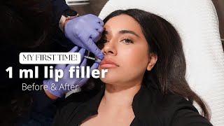 I GOT LIP FILLERS FOR THE FIRST TIME  1ML [upl. by Eekorehc]