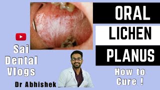 ORAL LICHEN PLANUS  HOW TO CURE [upl. by Okier480]