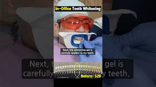 Inoffice Zoom Teeth Whitening [upl. by Claman190]