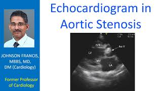 Echocardiogram in Aortic Stenosis [upl. by Attah]