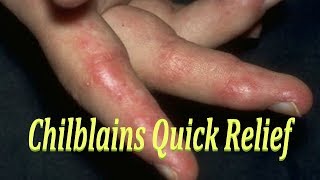 CHILBLAINS QUICK RELIEF  EASY HOME REMEDY FOR CHILBLAINS  CURE FOR बिवाई PERNIOSIS [upl. by Solhcin210]